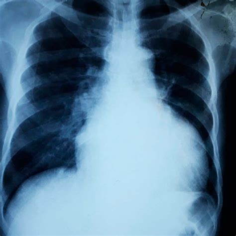 Posterior Anterior View Of Chest X Ray Showing Cardiomegaly With A Ctr
