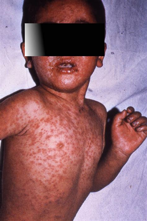 Infection Landscapes Measles Part 1 The Virus The Disease And The