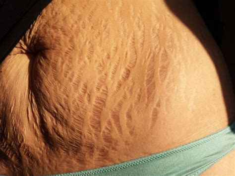 Love Your Lines Stretch Marks Go Viral In Support Of Women Troyrecord