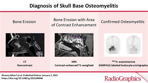 Diagnosis Of Skull Base Osteomyelitis Radiographics
