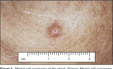Pdf Merkel Cell Carcinoma Of The Head And Neck Effect Of Surgical