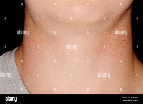 Swollen Lymph Gland Lymphadenopathy In The Neck In A 15 Year Old Male