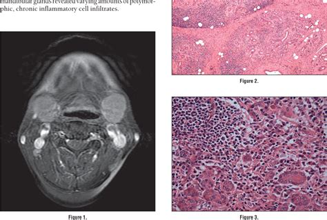 Figure 2 From Pathology Quiz Case 2 Chronic Sclerosing Sialadenitis