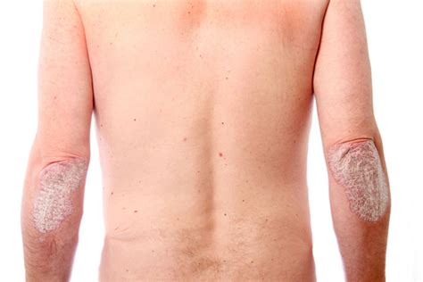 Understand The Causes Symptoms Types And Treatment Of Psoriasis