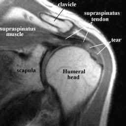 True joint capsule of the shoulder, extending from the glenoid labrum to the neck of the humerus. supraspinatus-muscle-and-tendon-mri.jpg (256×256 ...