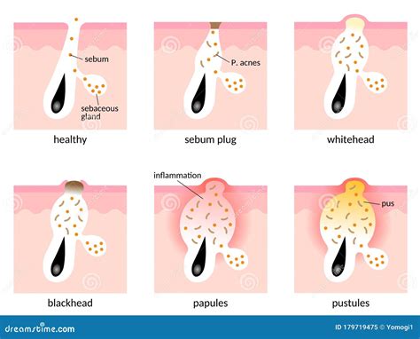 Acne Formation Papule And Pimple Vector Illustration Cartoondealer