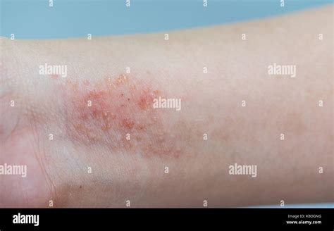Atopic Dermatitis Symptom Skin On Hand Stock Photo Alamy