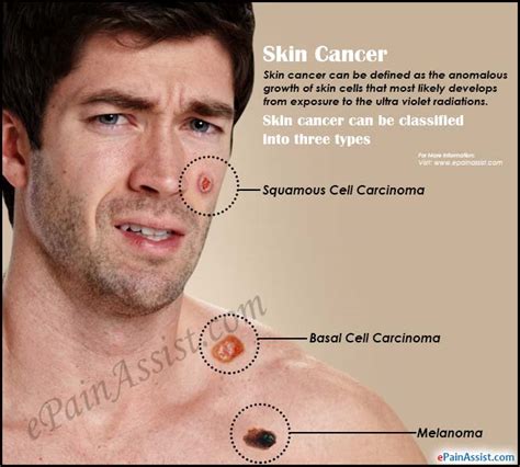 Warning Signs Of Skin Cancer Its Early Detection And Diagnosis 2C9