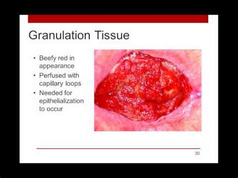 Wound granulation is an important stage in healing, where an injury fills with a matrix of fibrous connective tissue and blood vessels. WoundRounds Free Webinar - PUSH Tool for Monitoring ...