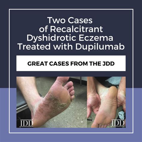 Recalcitrant Dyshidrotic Eczema Treated With Dupilumab Next Steps In