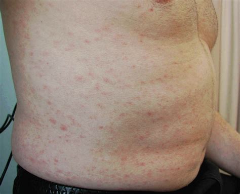 Covid Vaccine Rash Pictures Covid 19 Rashes How Your Skin Can Be A