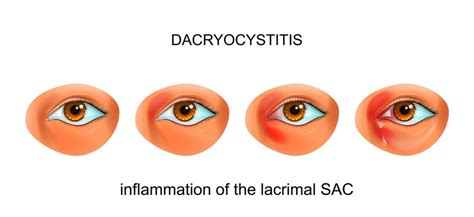 Tear Duct Infection Dacryocystitis Harvard Health