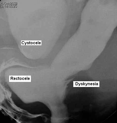 Colpo Cysto Dephecography Showing A Rectocele With Associated Cystocele Download Scientific
