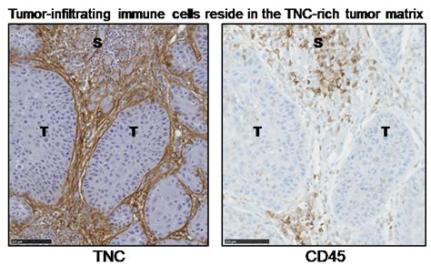 Immune Cells Held Hostage In The Tumor Stroma Ibv