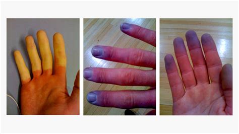 Raynauds Syndrome Phenomenon Symptoms And More