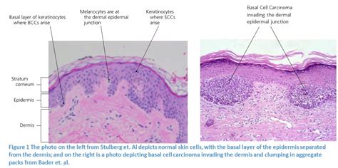 Basal Cell Carcinoma Mohs Surgery Basal Cell Carcinoma Mohs My XXX