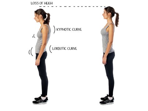 Fix That Hunch Back Hunch Back Kyphosis Is A Condition When There Is