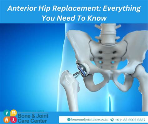Anterior Hip Replacement Everything You Need To Know