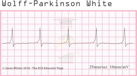 Preexcitation describes the situation in which impulses from the sa node or atrium reach the ventricle through an accessory. WPW - JapaneseClass.jp