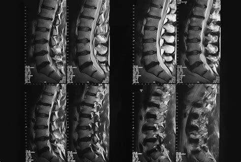 The Problem With MRIs For Low Back Pain Salon Com