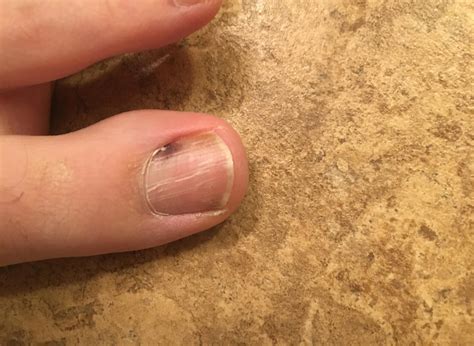 Why Does My Big Toenail Have White Spots Design Talk