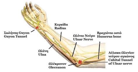 Ulnar Nerve Entrapment at the Elbow - Dr. Groh