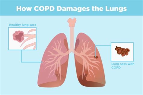 Copd And Arthritis Whats The Connection