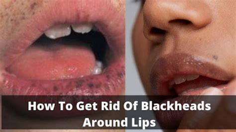 How Do I Get Rid Of Blackheads Around Lips Naturally