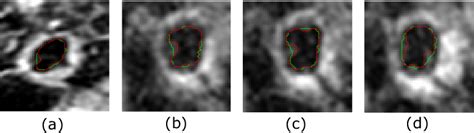 Impact Of The Chan Vese Active Contour On The Final Segmentation