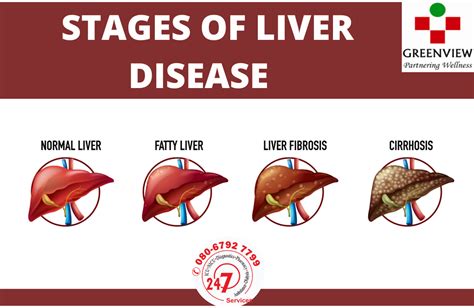 Stages Of Liver Disease Liver Disease Liver Problems Liver Care