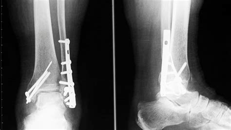 Lateral Malleolus Fracture Lateral Malleolus Fracture Treatment