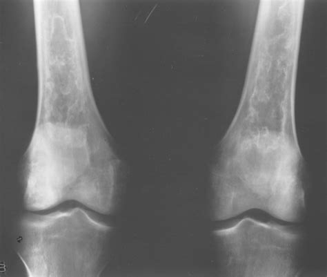 Benign Cystic Bone Lesions Radiology Key