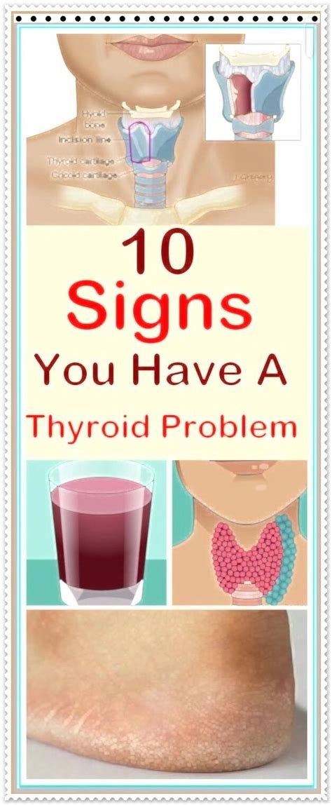 10 Signs You Have A Thyroid Problem And 10 Solutions For It In 2020