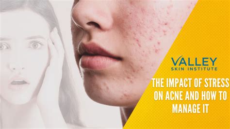 The Impact Of Stress On Acne And How To Manage It Valley Skin Institute