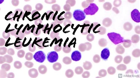 Chronic Lymphocytic Leukemia Cll Peripheral Blood Smear Hemepath