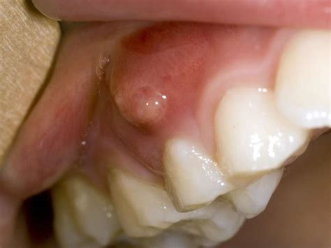 Bump On Gums Causes And How To Treat Them The Best Porn Website