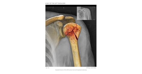 Humeral Shaft Fracture Usmle Strike Hot Sex Picture