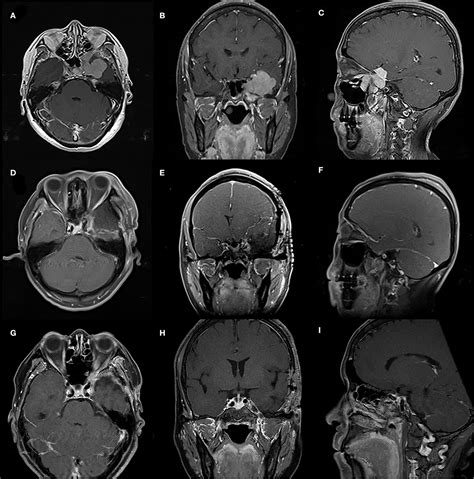 Frontiers Management Of Skull Base Meningiomas With Extracranial