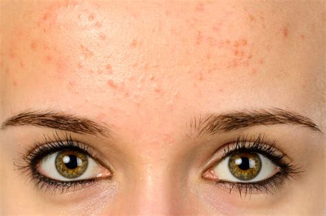 How To Treat Fungal Face Acne Be Beautiful India Riset