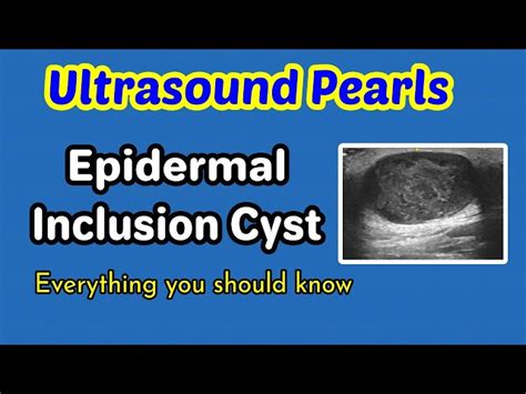 Subcutaneous Dermoid Cyst Ultrasound