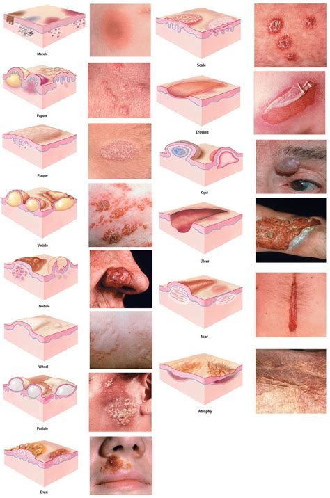 Dermatology Skin Lesion Atlas Skin Lesions Atlas Map