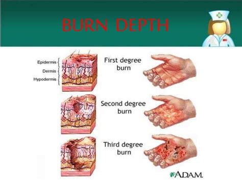 Anesthesia For Burn Patient