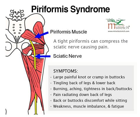 Pain Relief Learn The Symptoms Of Piriformis Syndrome Get Relief With