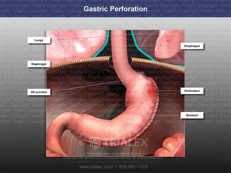 Gastric Perforation Trial Exhibits Inc