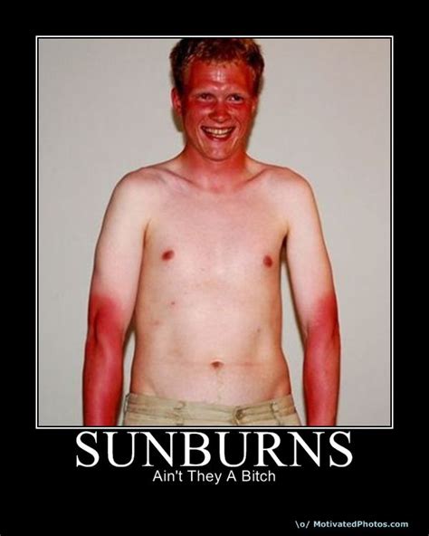 Isnt Sunburn The Worst Off Topic Giant Bomb
