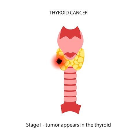 Premium Vector Thyroid Cancer Stages