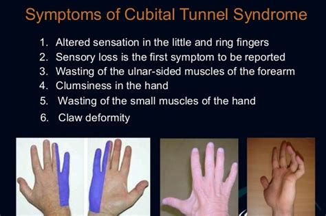 Cubital Tunnel Syndrome Presentation And Treatment Bone And Spine
