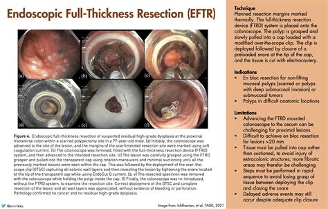Endoscopic Full Thickness Resection My Xxx Hot Girl