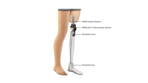 Amputation And Osseointegration — Dr Phil Huang
