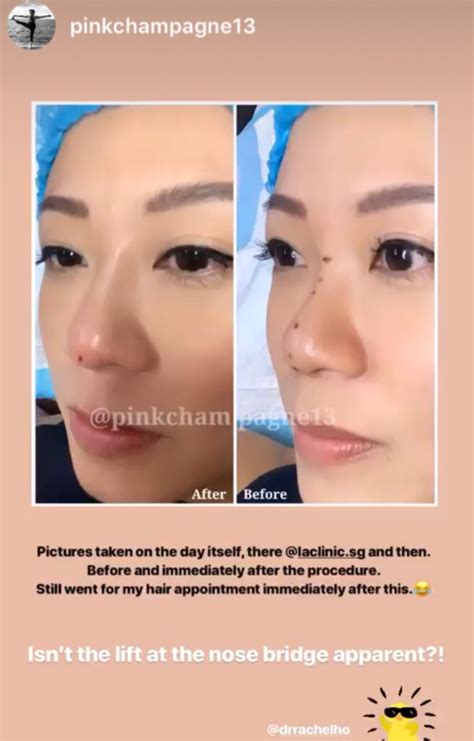 Dr Rachel Ho Pinkchampagne13 Nose Threadlift Before After